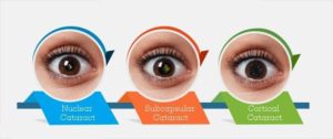 types of cataract | Cdas Hospital